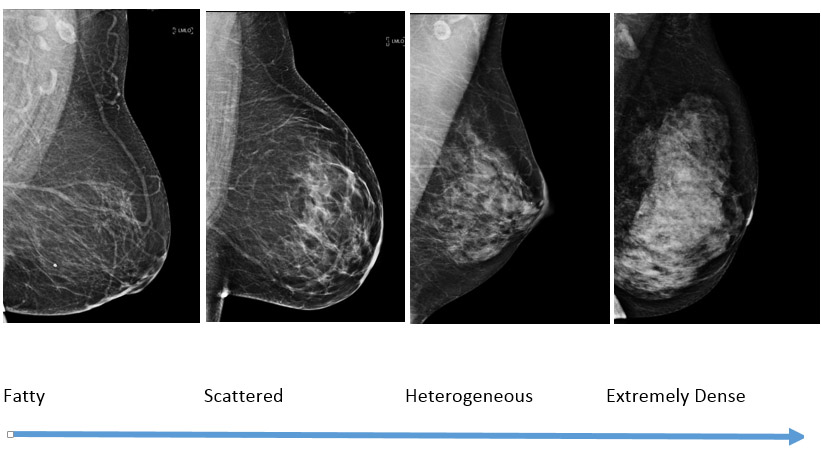 Breast Density Robert H Lurie Comprehensive Cancer Center Of Northwestern University 