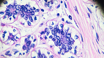 pathology scan of breast-cancer tissue